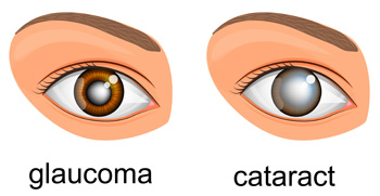glucoma image
